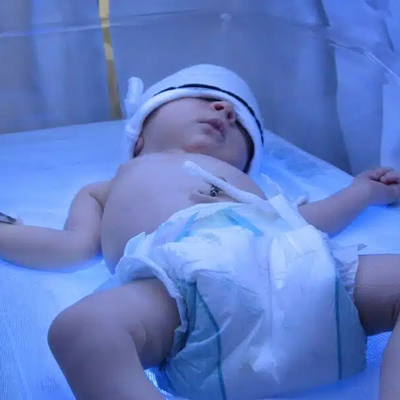 هزینه اجاره دستگاه زردی نوزاد